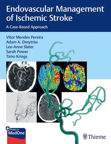 Endovascular Management of Ischemic Stroke A Case-Based Approach by Vitor Pereira