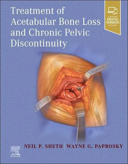 Treatment of Acetabular Bone Loss and Chronic Pelvic Discontinuity by Neil P. Sheth