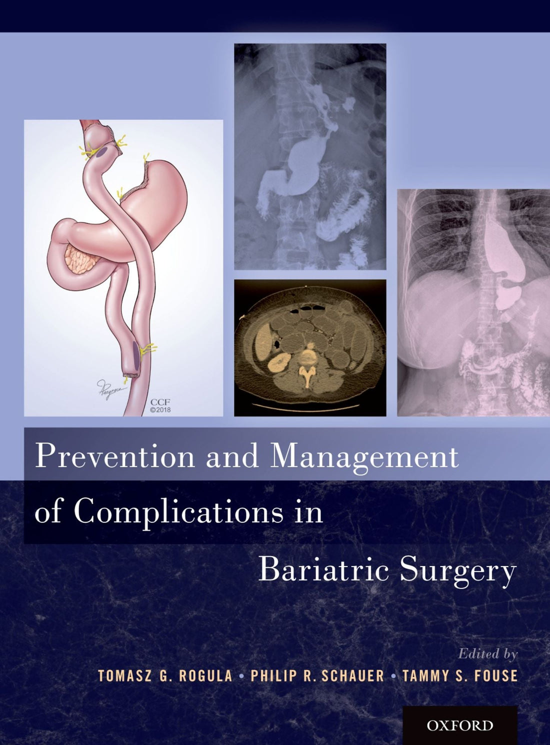 Prevention and Management of Complications in Bariatric Surgery