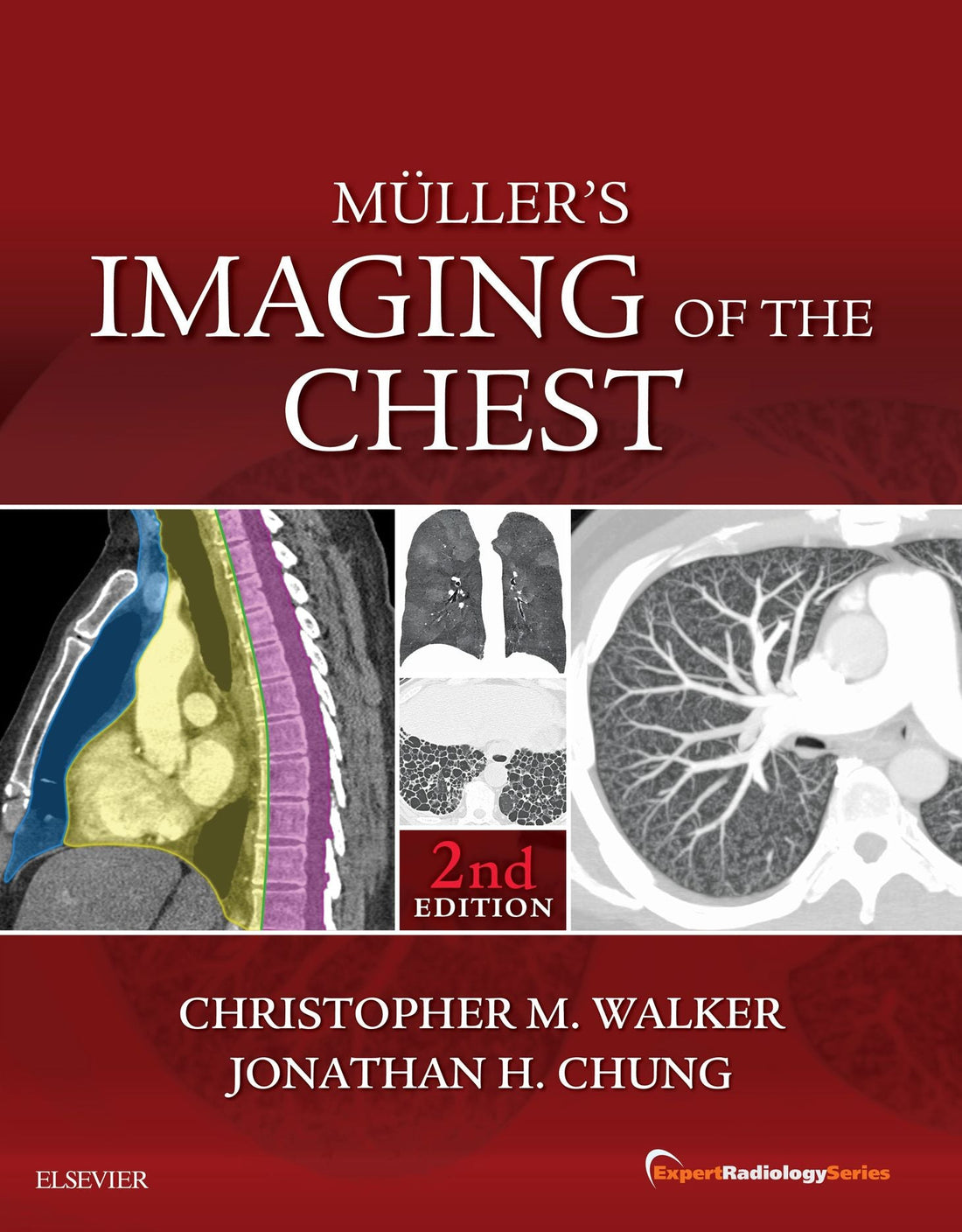 Muller's Imaging of the Chest E-Book: Expert Radiology Series