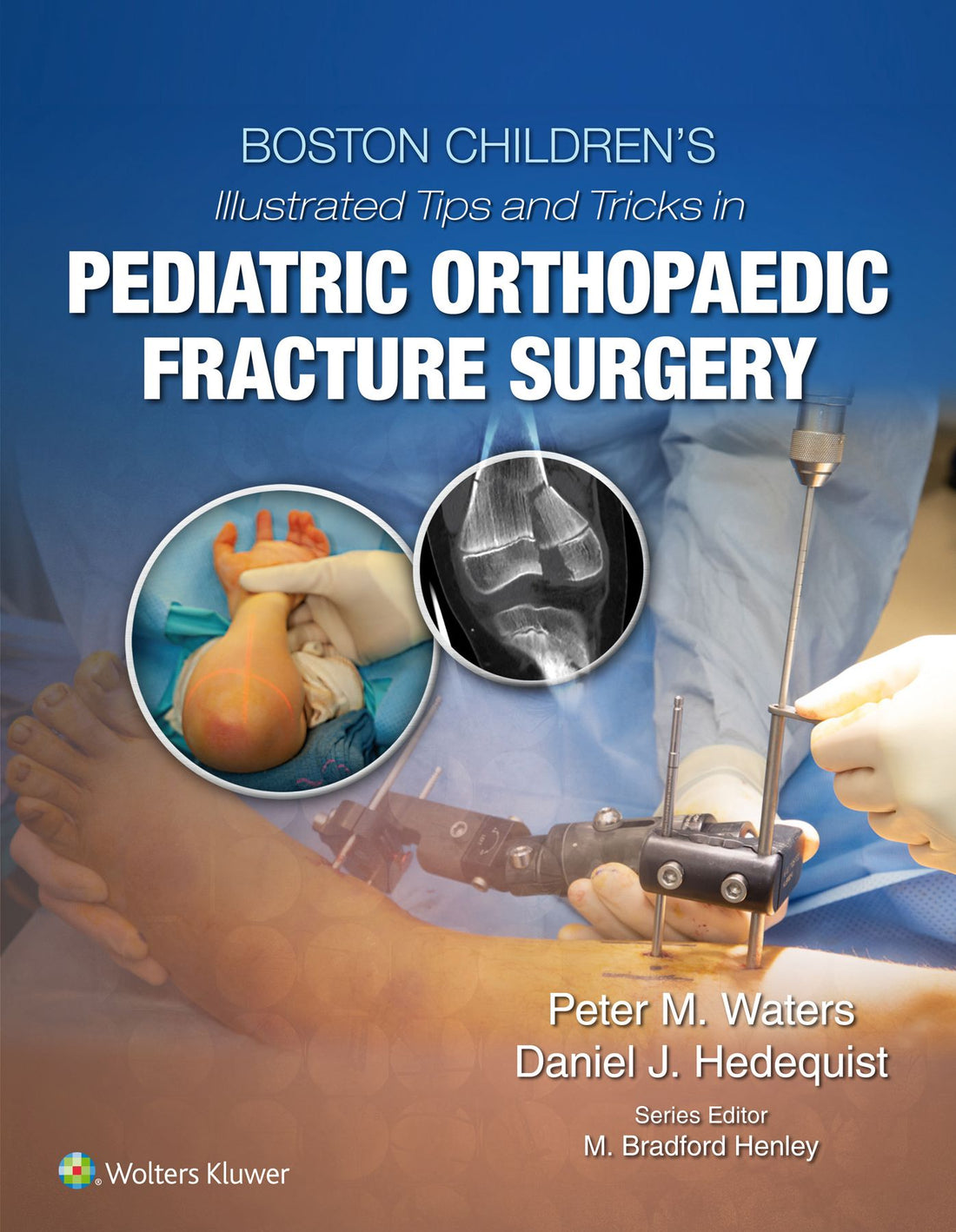 Boston Children's Illustrated Tips and Tricks in Pediatric Orthopaedic Fracture Surgery